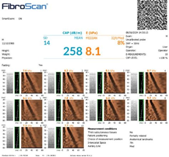 Understanding Your FibroScan Test Results